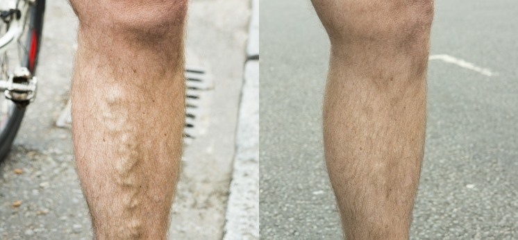 Laser varicose vein removal